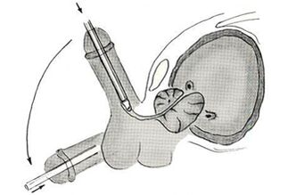 Esquema de cirugía endoscópica de agrandamiento del pene. 