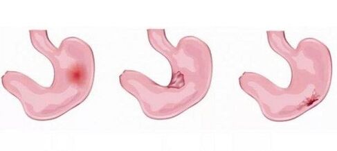 problemas de estómago como contraindicación para el agrandamiento del pene con refrescos