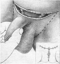Alargamiento quirúrgico del pene sacando su parte oculta