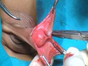 Cirugía de agrandamiento del pene masculino